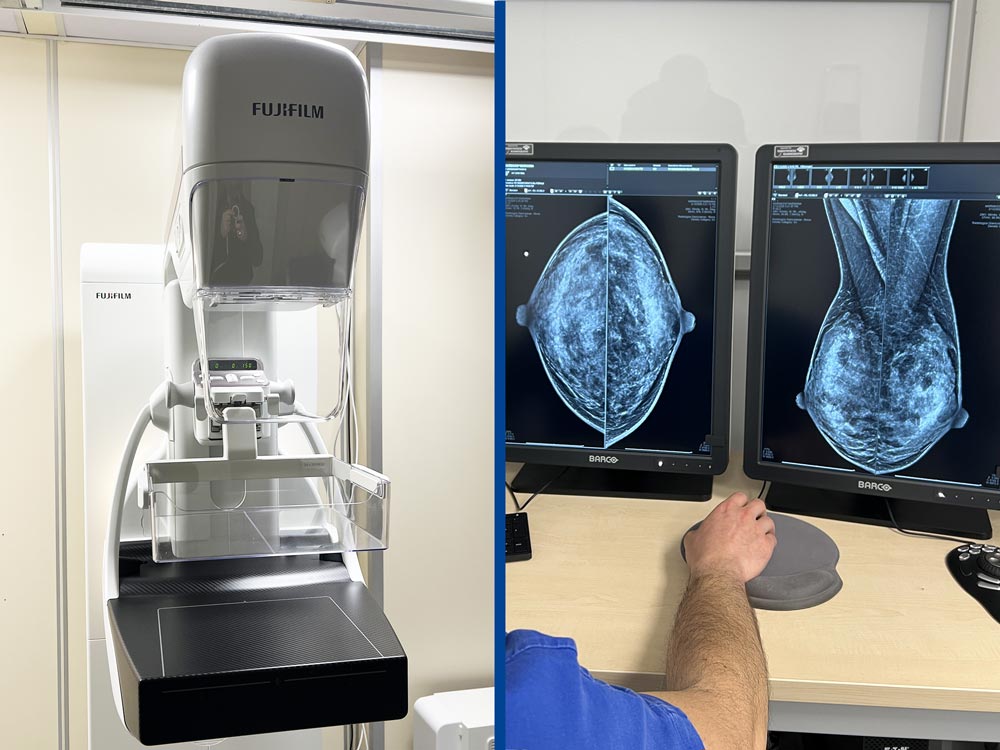 vantaggi della mammografia con tomosintesi